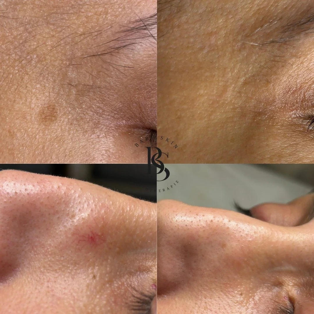 Deze mevrouw had last van een pigmentvlek en een spider naevus. Na slechts &eacute;&eacute;n behandeling zijn deze volledig verdwenen. Voor de behandeling hebben we gebruik gemaakt van onze Clarity II laser van Lutronic. Voor het pigment hebben we de