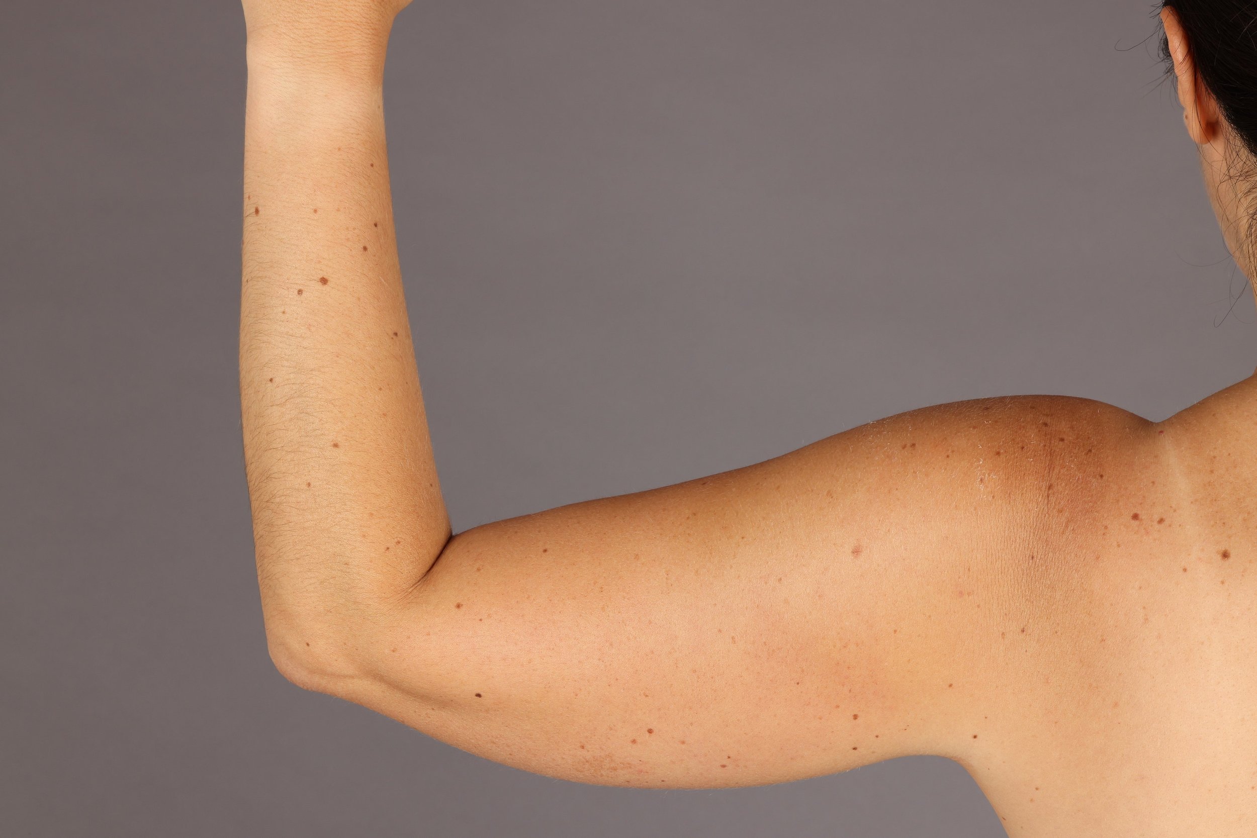 Top 5 Signs It’s Time for Total Body Photography