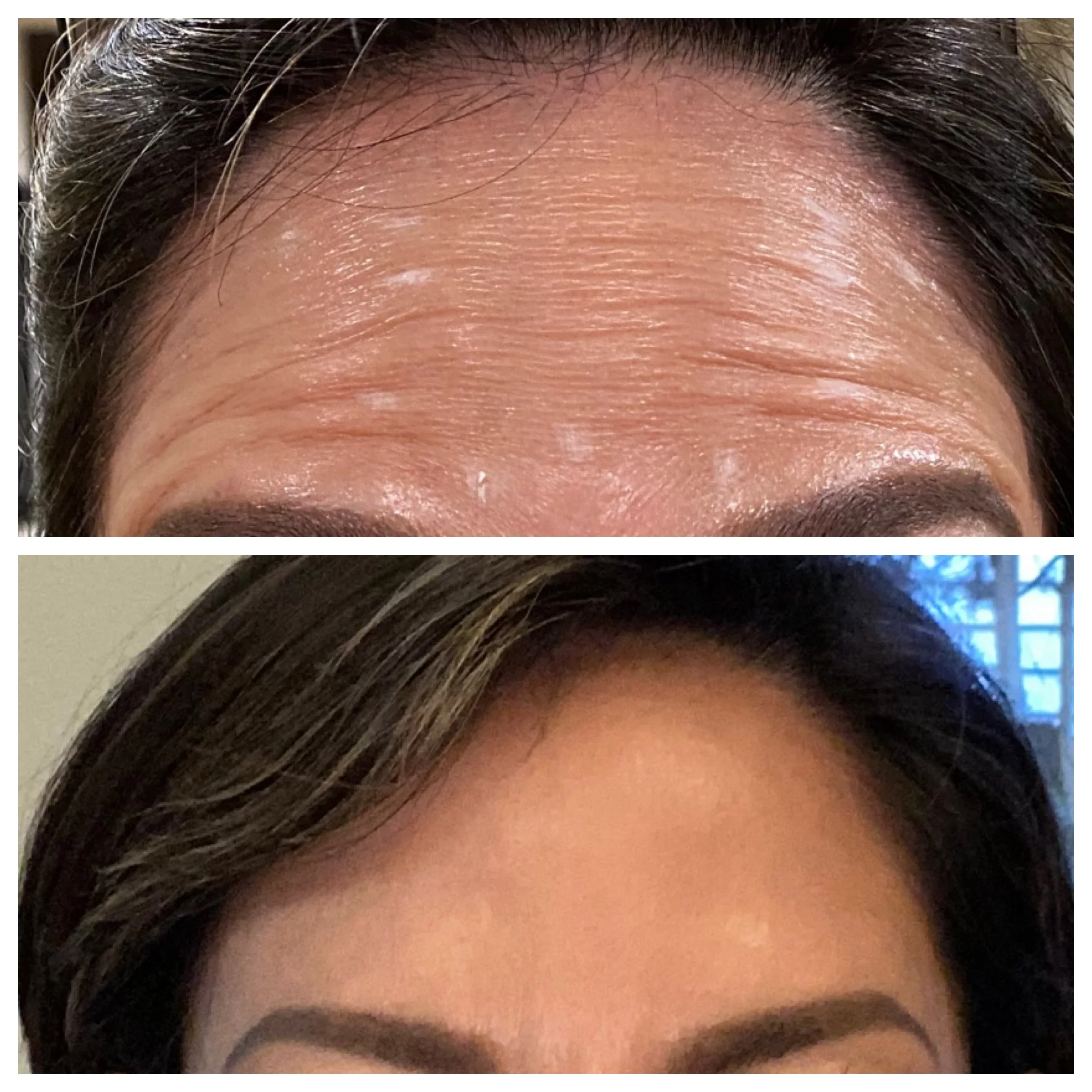 Botox before & after Botox