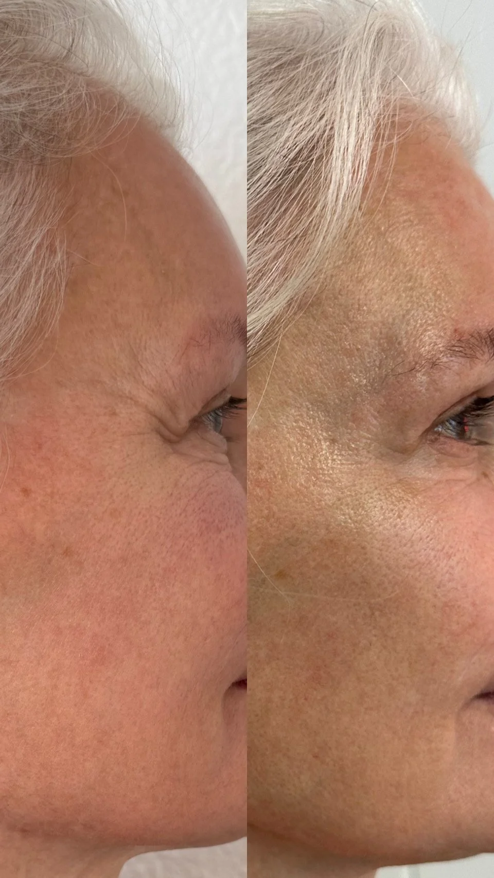 Before and after close-up images of a woman’s face showing improved skin tone and texture, likely from a skincare treatment.