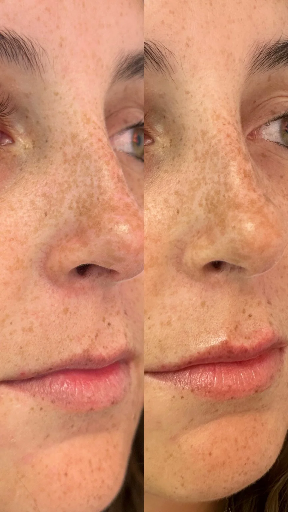 Close-up of a person's face showing before and after images of skin improvement, focusing on freckles, skin texture, and lips.