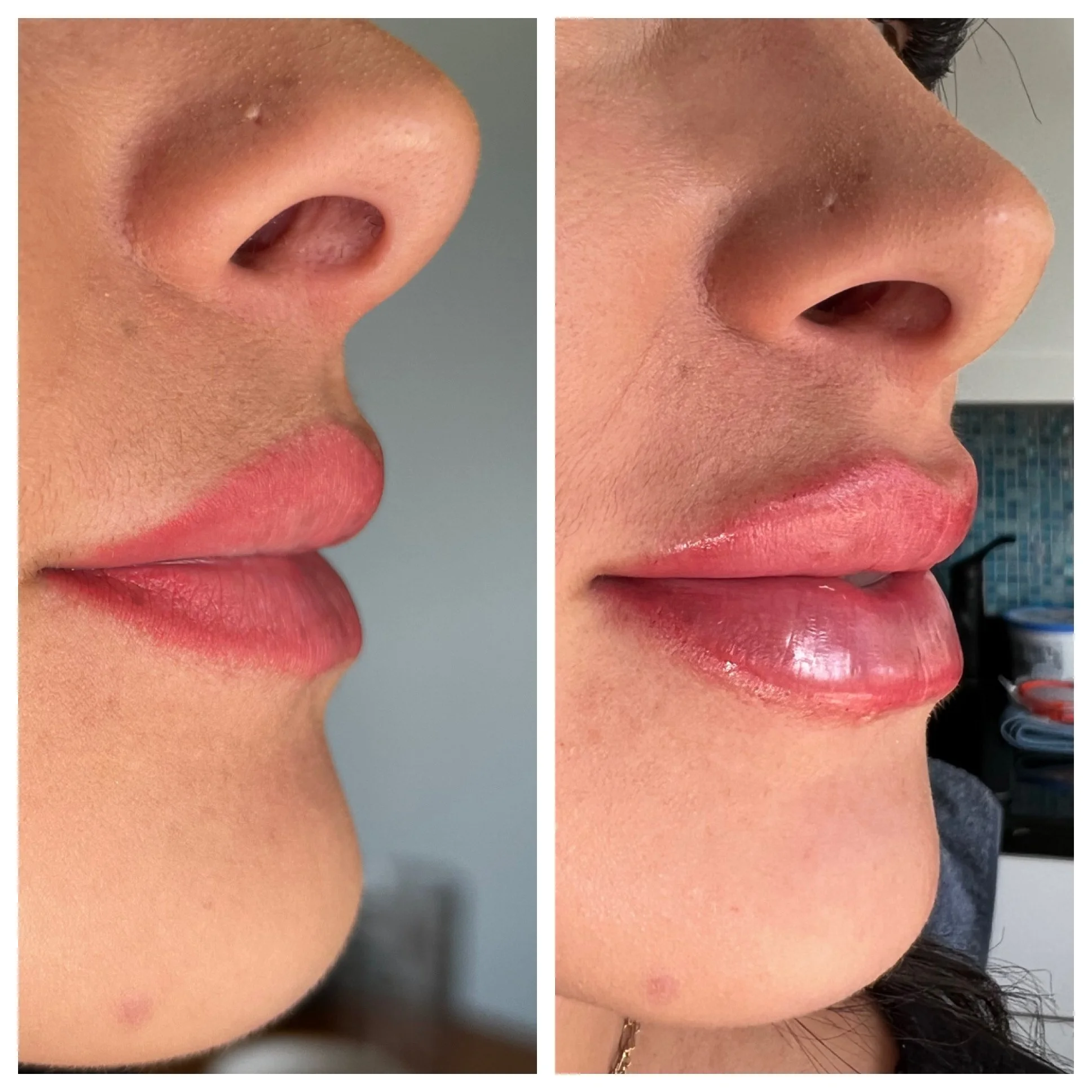 Lip Filler. Before & Immediately After