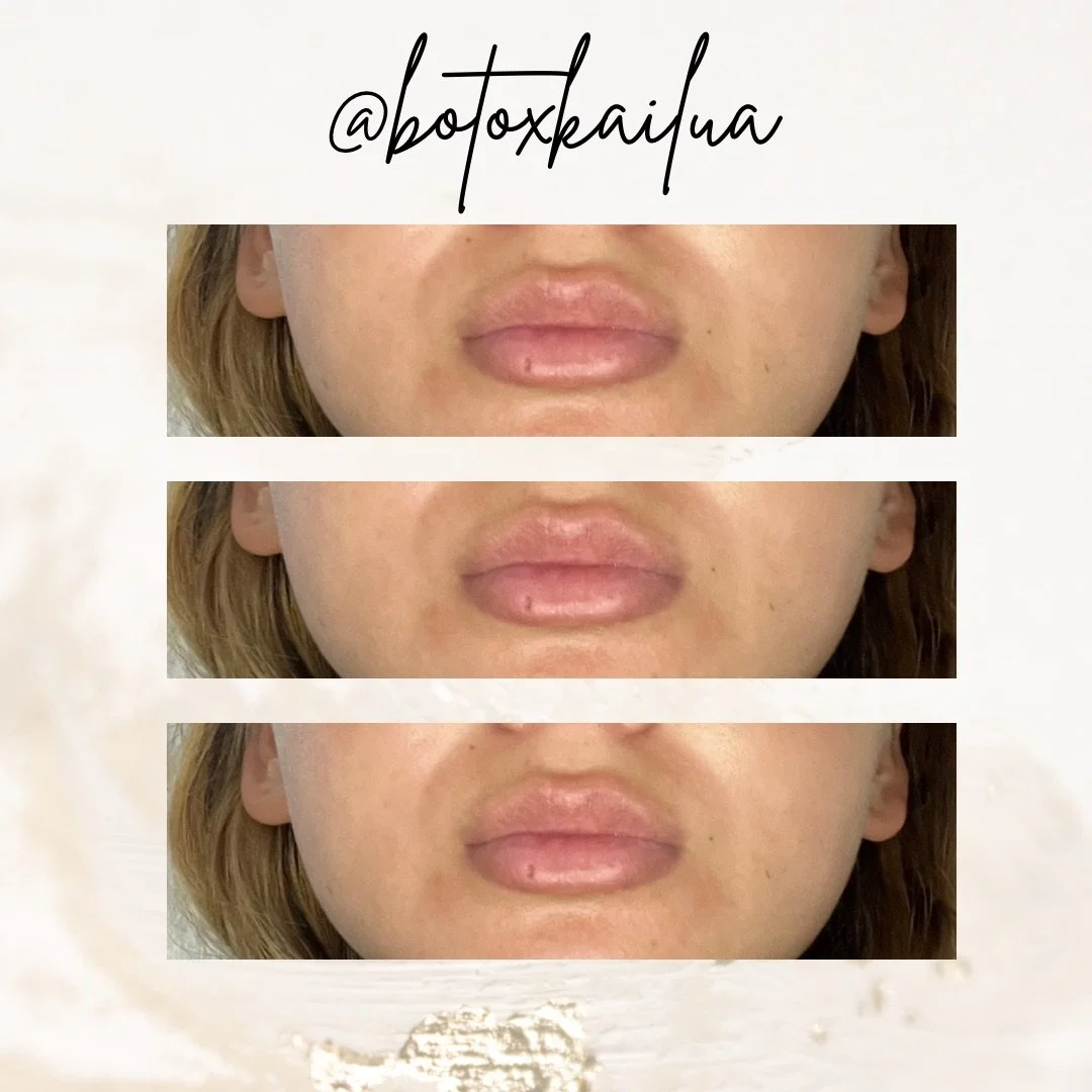 Lip Flip using Botox 