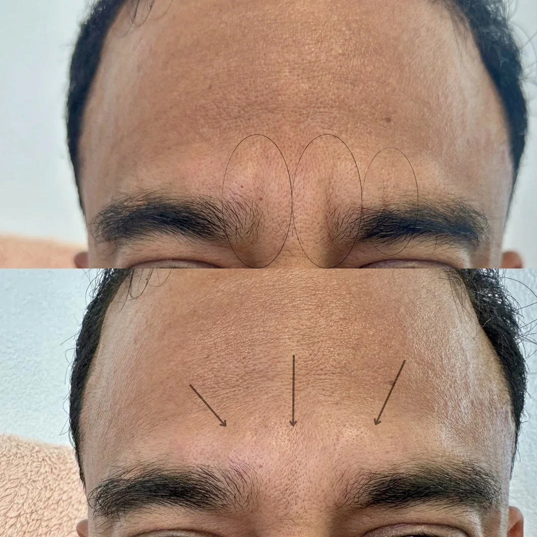 Close-up of a man's forehead showing before and after images of a cosmetic treatment. The top image displays visible wrinkles and lines on the forehead, while the bottom image shows a smoother forehead with arrows pointing to the areas of improvement