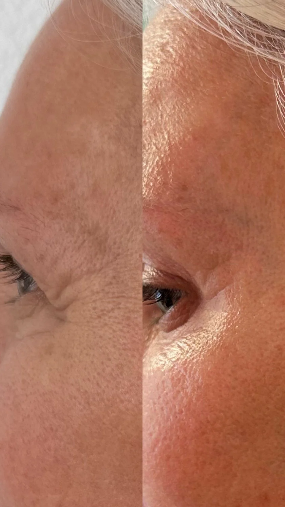 Close-up of a person's face with uneven skin texture and large pores, showing a before-and-after comparison of skin improvement.