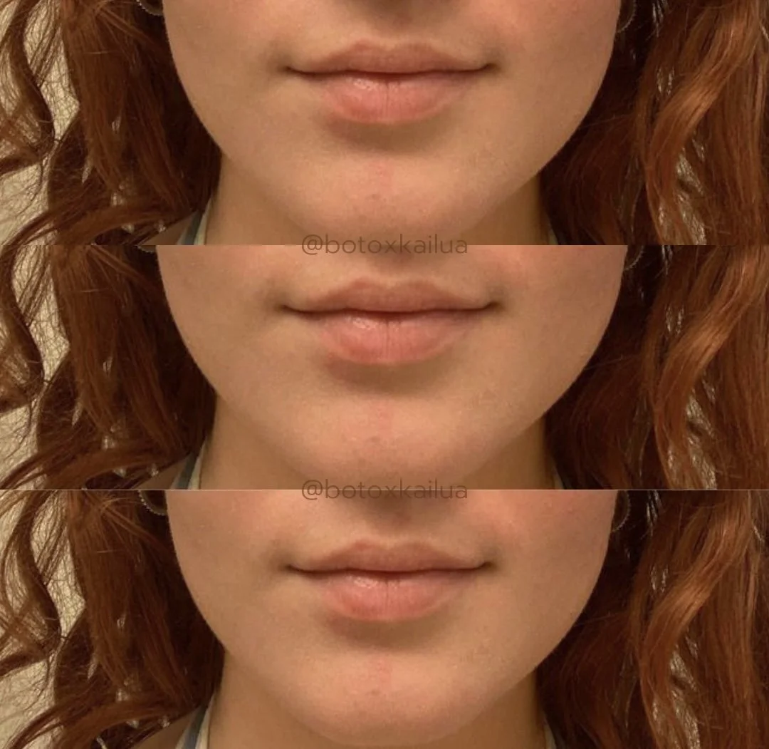 Close-up of a woman's lips, showing a before, during, and after comparison of a cosmetic treatment or procedure. The woman has red, wavy hair.