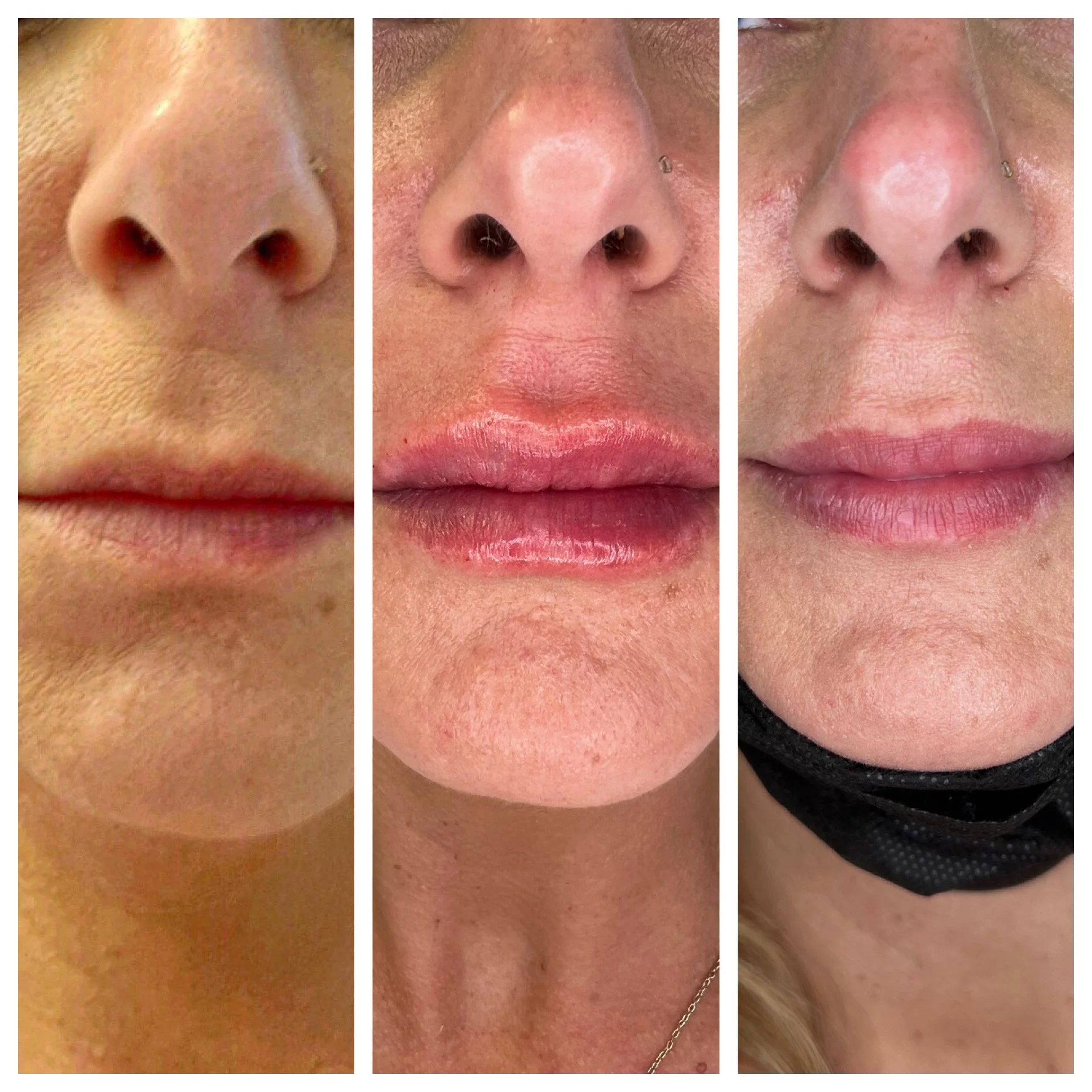 Before--  immediately after lip filler --  3 months post procedure