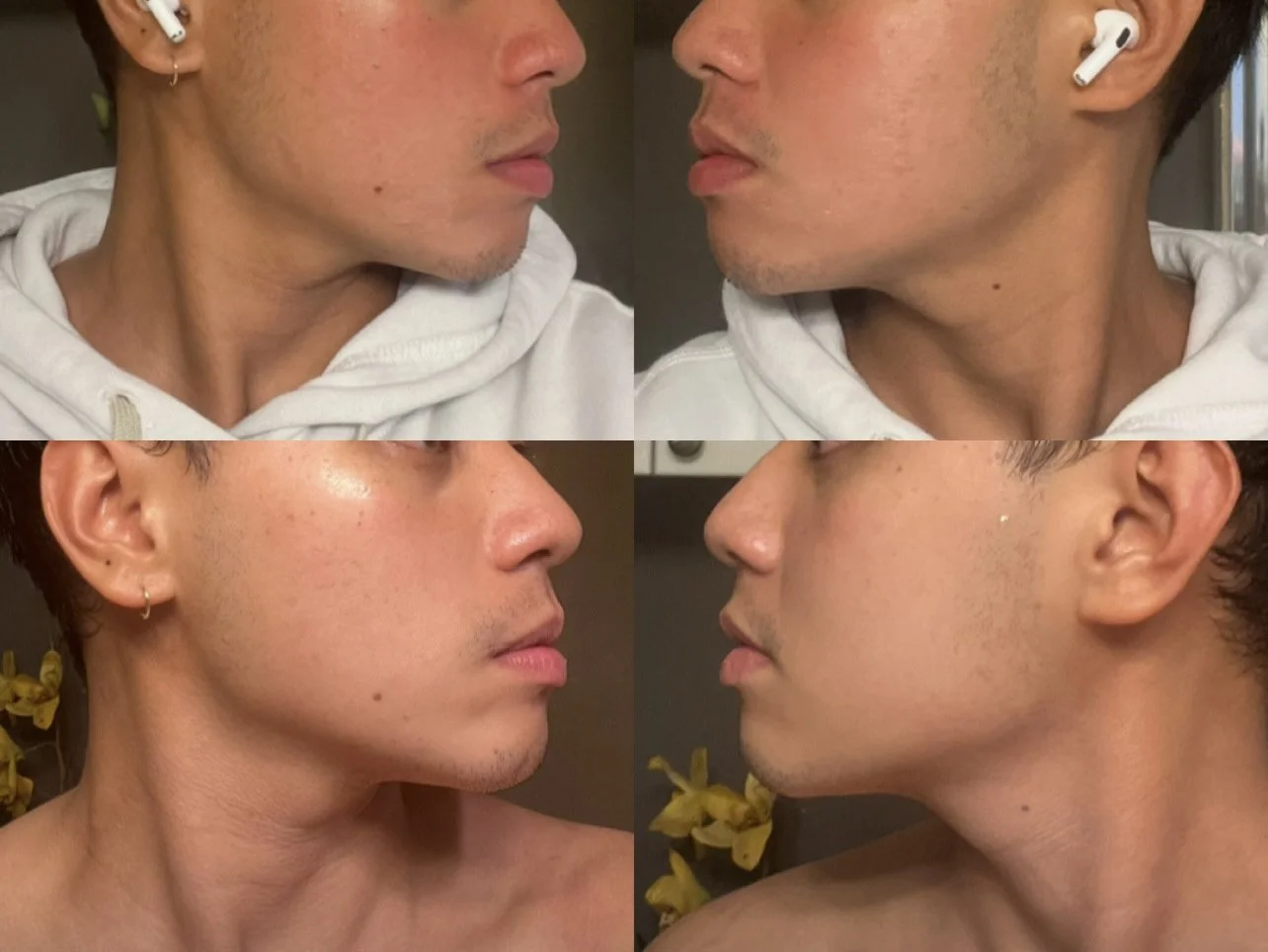 Comparison of close-up side profiles of a young man before and after skin treatment, showing visible improvement in skin clarity and texture.