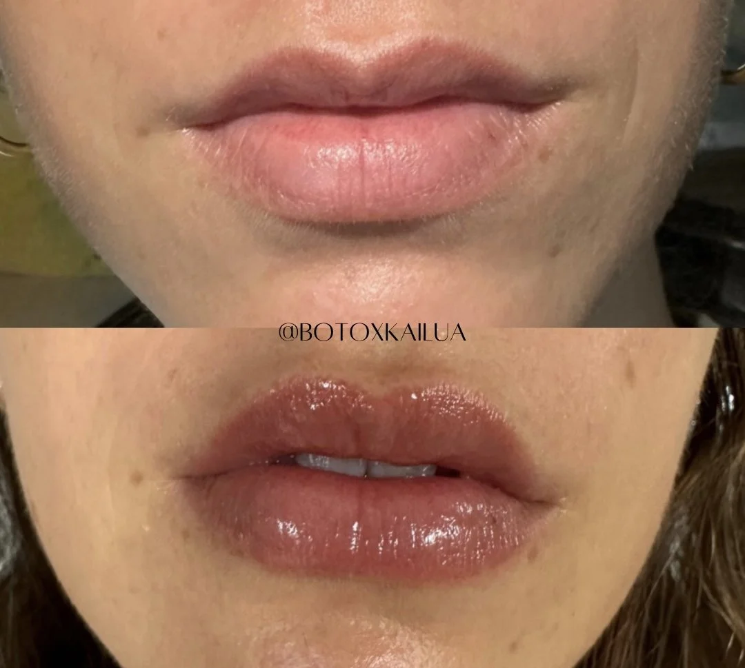 Close-up comparison of lips before and after a cosmetic lip treatment. The top shows natural lips, the bottom shows lips with glossy, enhanced appearance.