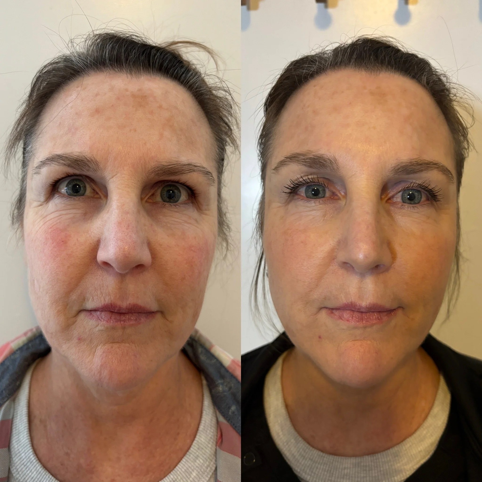 Beth PDO Threadlift.jpeg