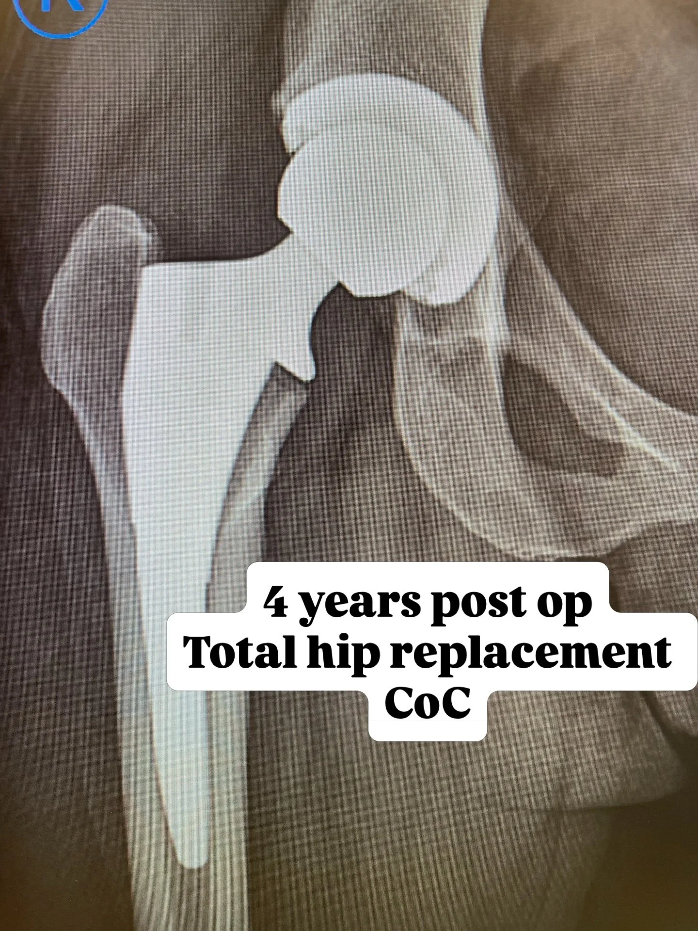 Healing takes time.

Everyone&rsquo;s journey is different. 
Mine was bumpier than expected&hellip;
Nerve pain lasted longer than I hoped
I accidentally got frost bite from using my ice machine to bring down swelling
PT wasn&rsquo;t progressing as fa