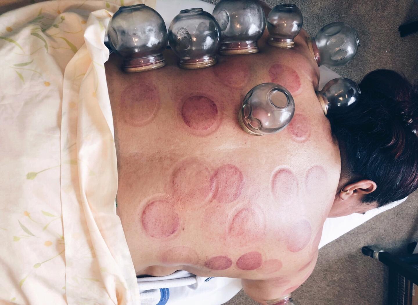 &bull; cupping therapy to increase blood circulation &bull;

In this case of chronic back pain, shoulder pain and numbness/tingling extending into her fingers, she felt immediate relief from her months of pain after this session 👏🏼 

Like most form