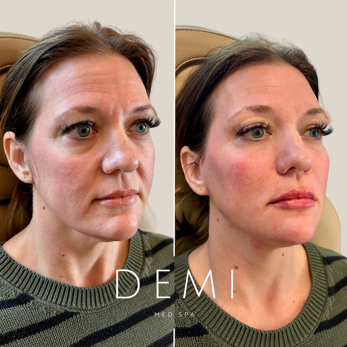 FACE FILLERS BA - Feed - 1.PNG