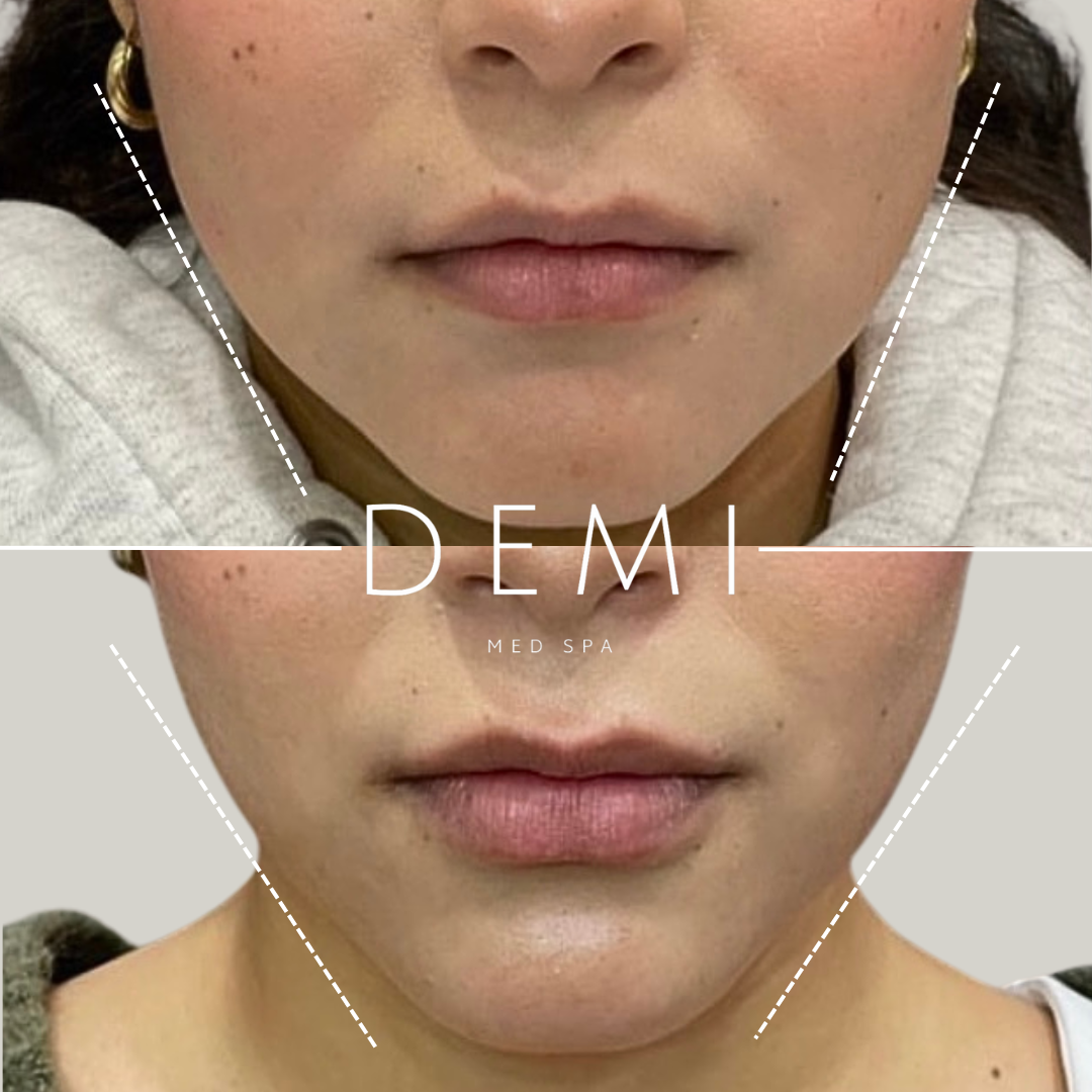 BOTOX MASSETER BA - Feed-4.png