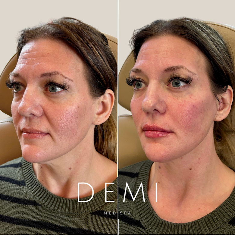 FACE FILLERS BA - Feed - 2.PNG