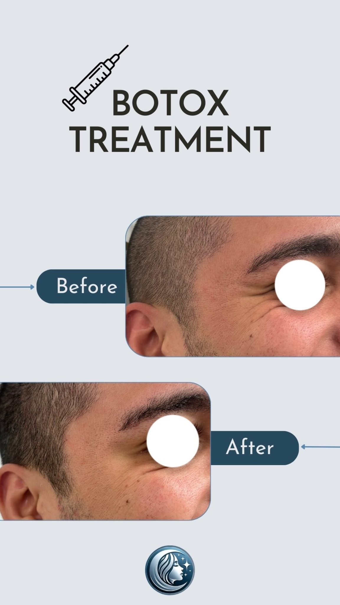 Botox Treatment sina.jpg