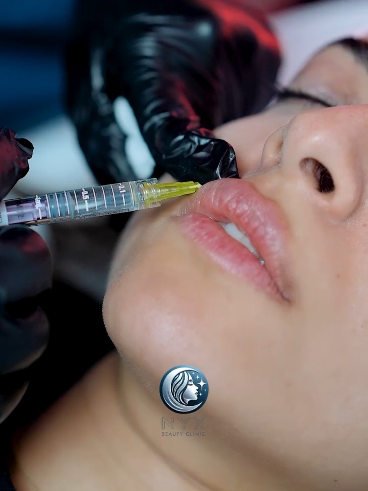Lip Filler.jpg
