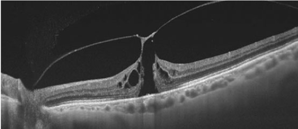 Optical coherence tomography (OCT) scan of a full thickness macula hole