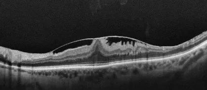 Optical coherence tomography (OCT) scan of an epiretinal membrane
