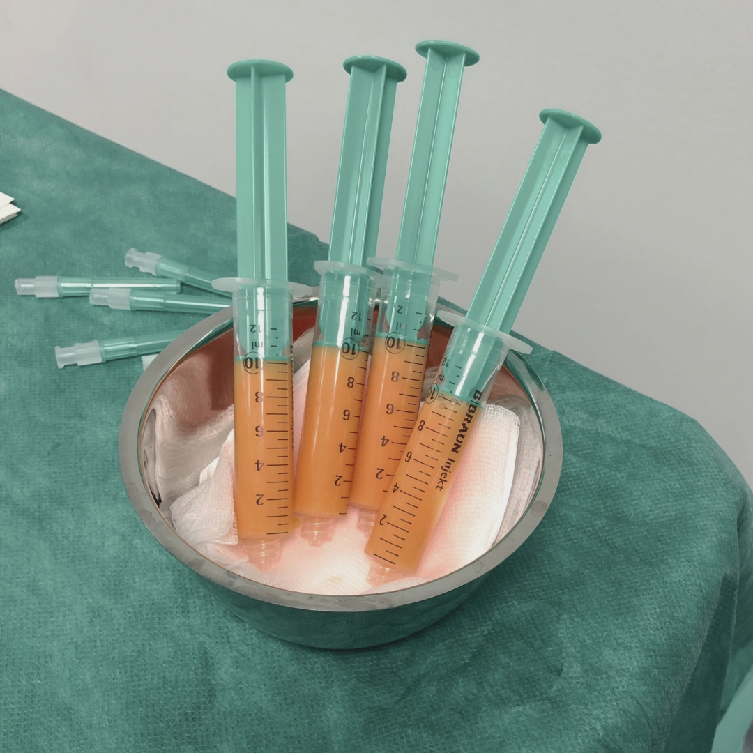 Lipotransfer zur Körperformung und Vergrösserung von Brust & Po