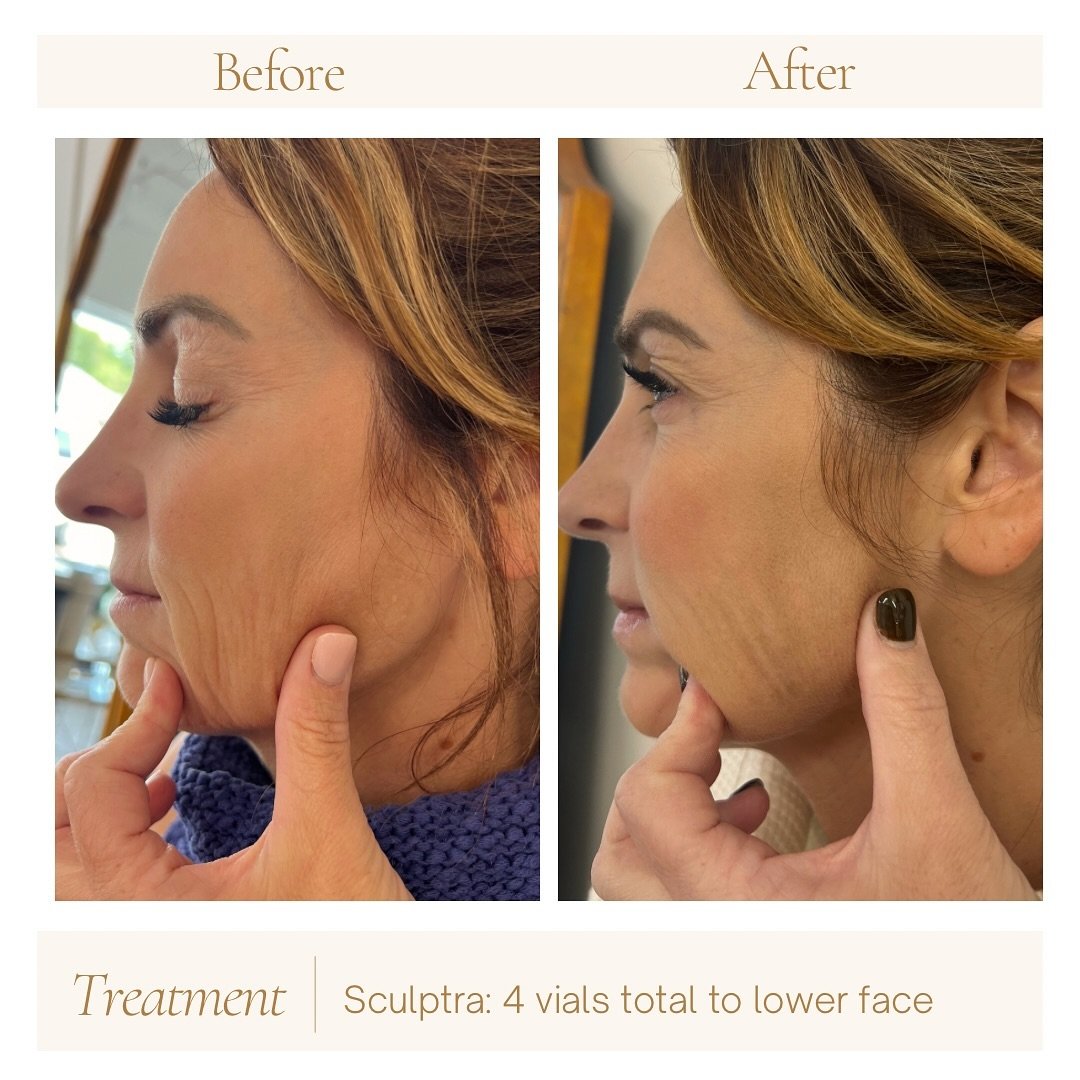 Sculptra is a collagen stimulating filler, restoring your skin from the inside out. 🪄 Think of it as fertilizer for your face! 

A biostimulator, Sculptra tells your body to produce your own Type 1 collagen and has sustained results of up to 2 years