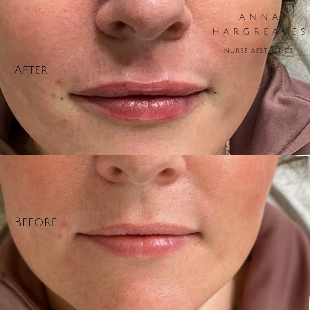 Beautiful and natural looking lip filler. 

This will only be achieved if you know how!!

Are you ready for your lip journey to begin.

Click the link in my bio to book 👆

&bull; 📱 07540184844
&bull; 👩&zwj;🦳 Anna Hargreaves RGN INP
&bull; 📍Sandb