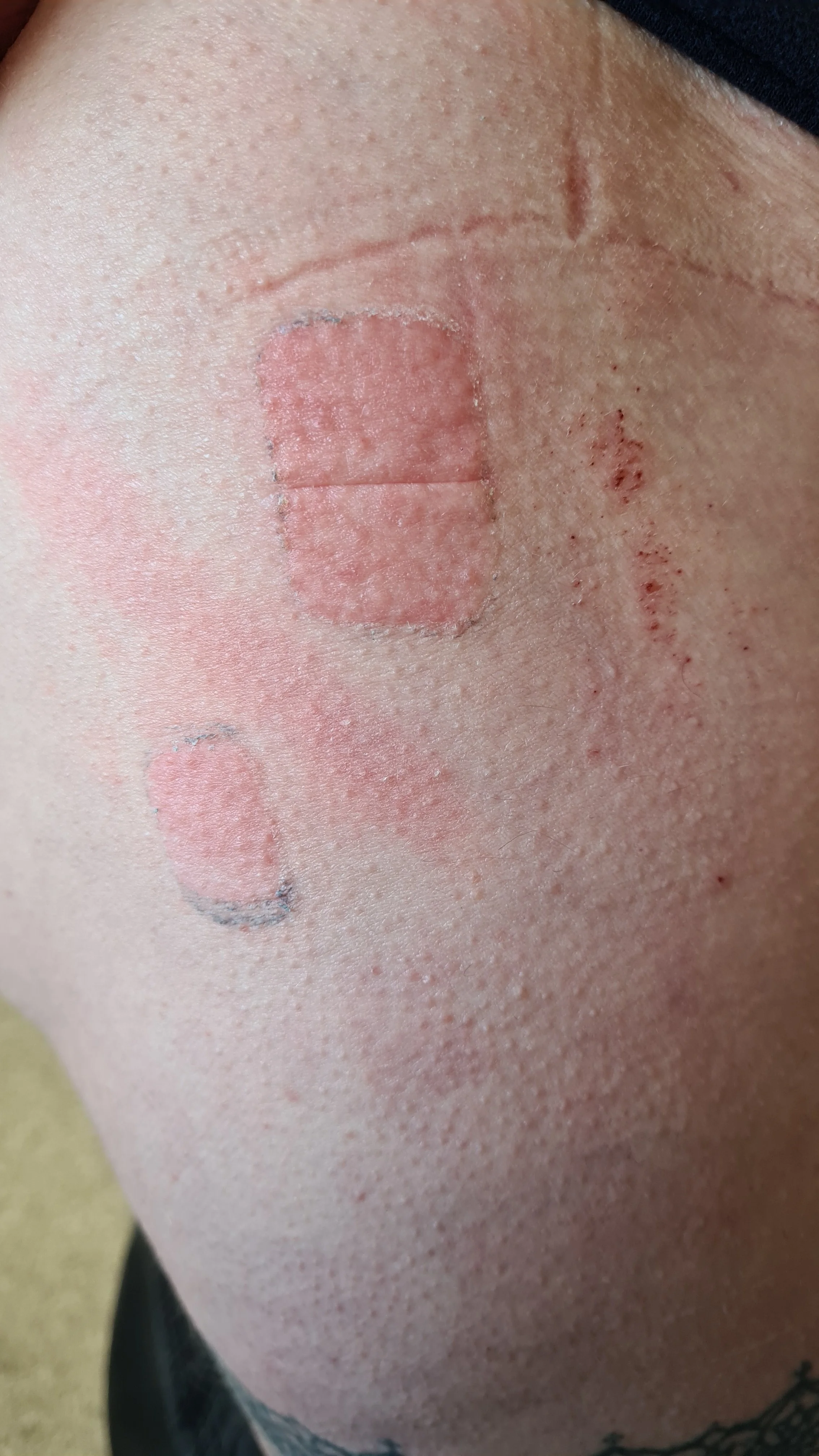 skin rash Apr '24.jpg