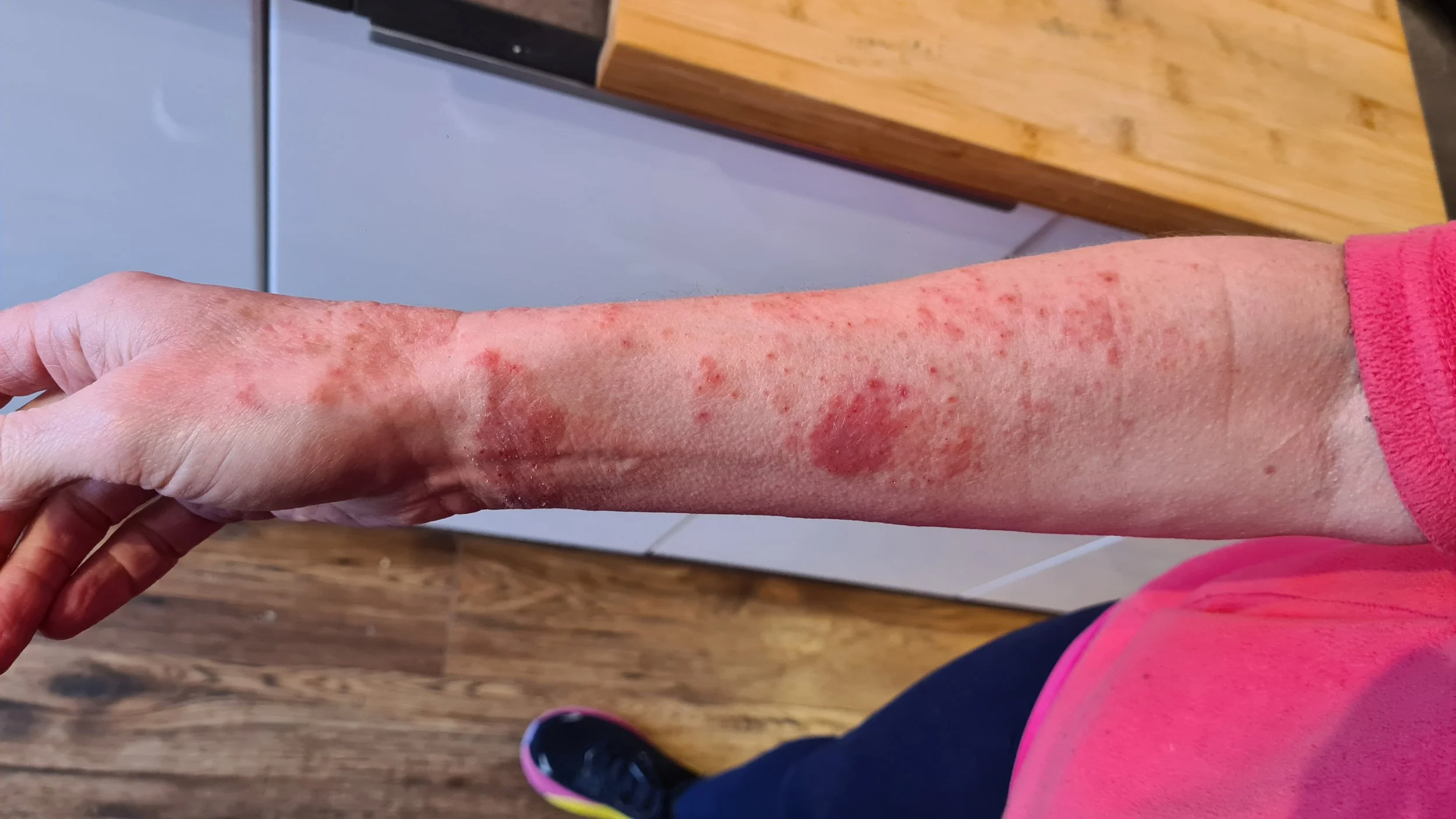 Skin forearm Beg 2024.jpg