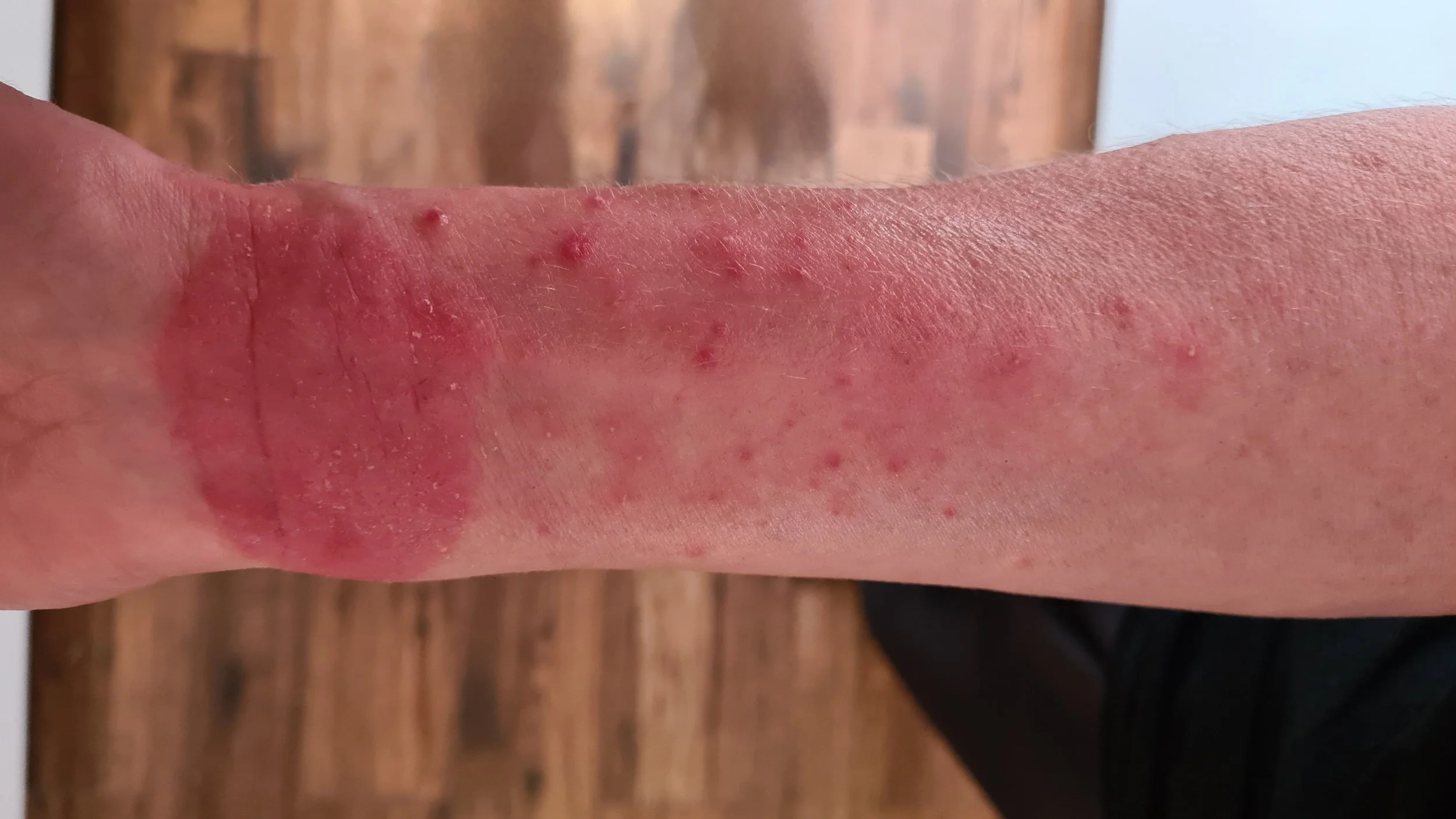 With Lenzetto July 2025