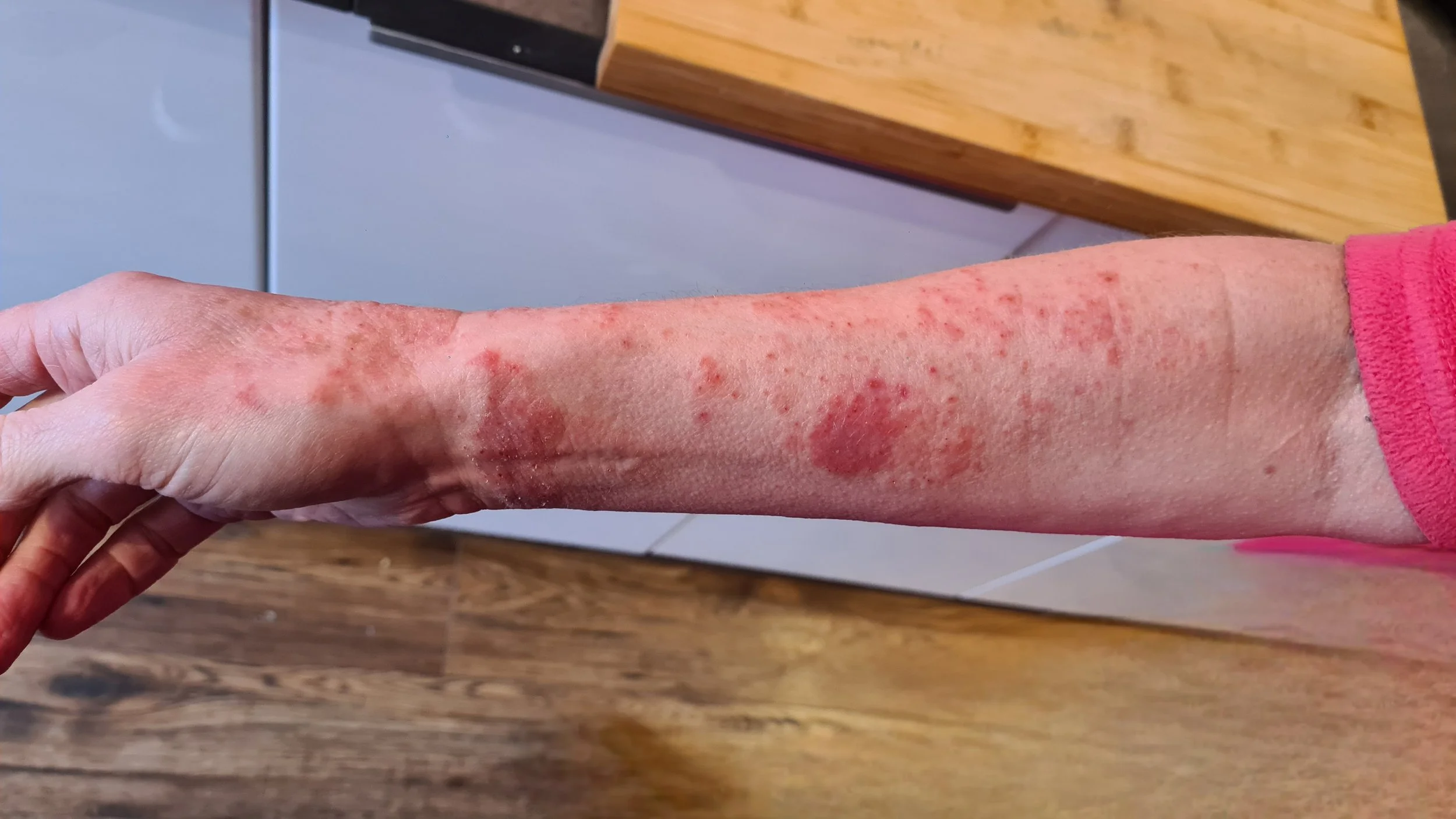 Histamine Hell - Part 1