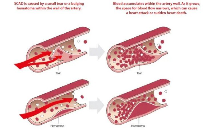Diagram of 4 heart arteries, representing blood flow when there is a tear or haematoma.