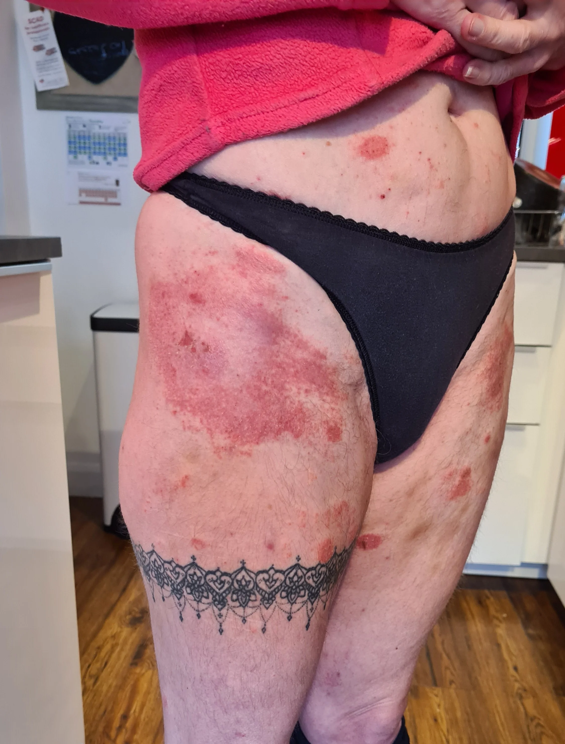 Sores on thighs due to a histamine response to oestrogen