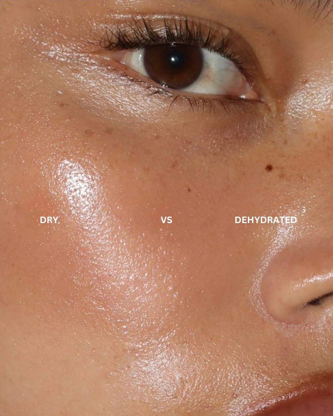 Dry skin and dehydrated skin aren't the same thing.
Dry skin is a skin type that lacks natural oils. 

Dehydrated skin is a temporary condition caused by a lack of water.

Knowing the difference can make it much easier to choose products that actuall