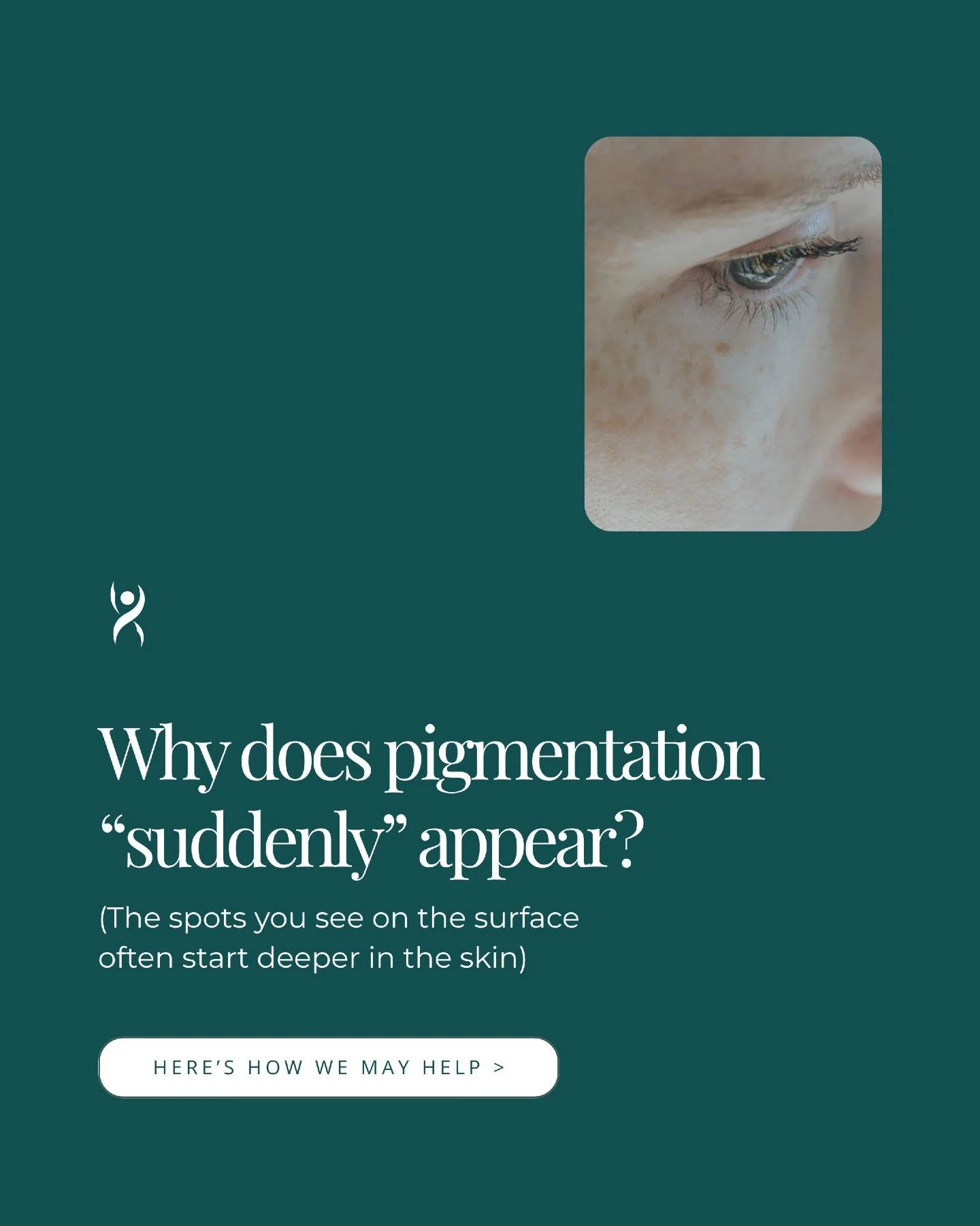 If you've noticed new dark spots or uneven skin tone creeping up, you're not alone (and it's more common than you might think.)

Pigmentation can appear to come out of nowhere, but it's usually the result of cumulative sun exposure, hormonal changes,