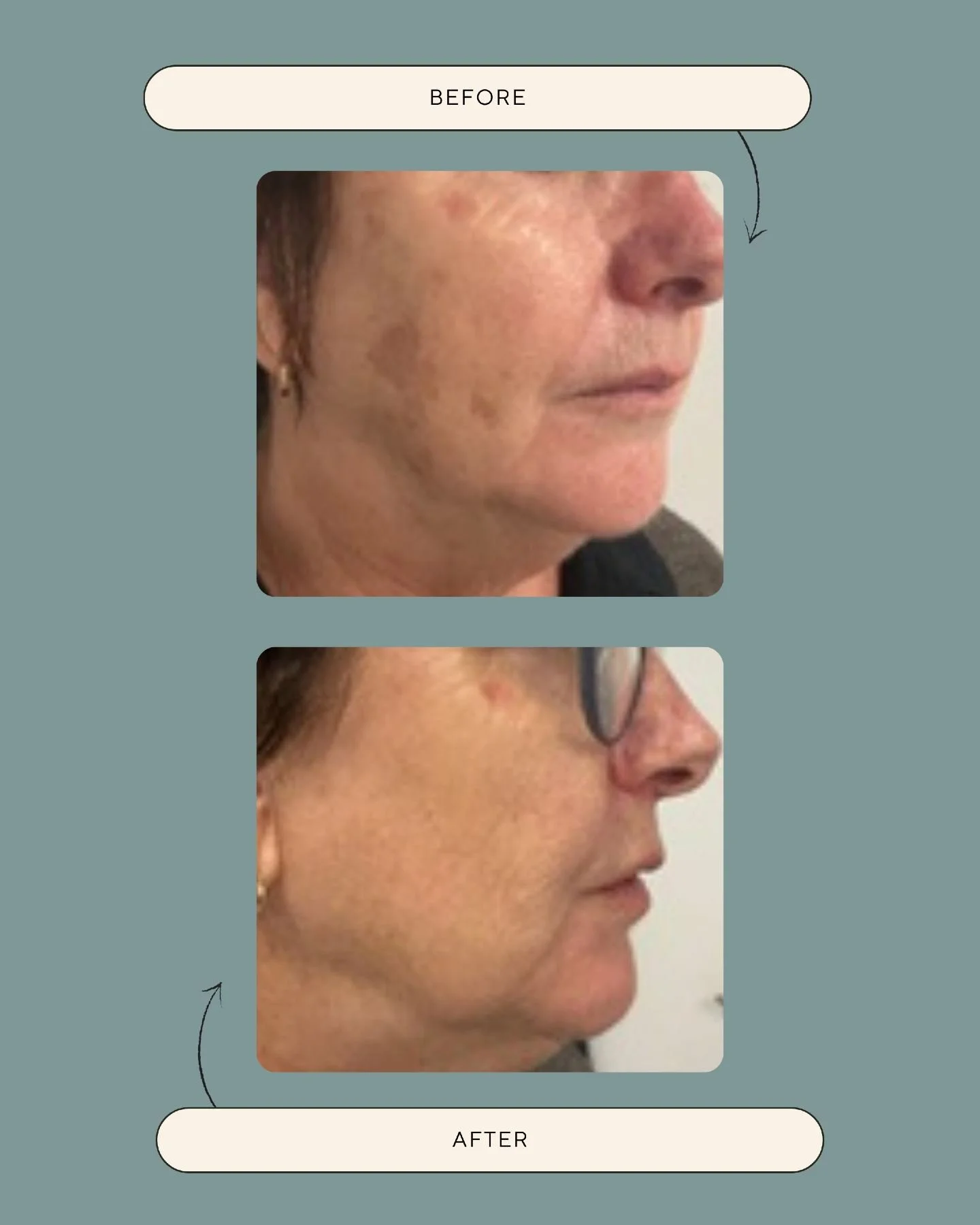 Results like this are just another reason why we love what we do.

This client came to us with concerns about their skin tone and texture. After laser resurfacing treatment with Nurse Kellie, you can see the difference in the overall appearance and q