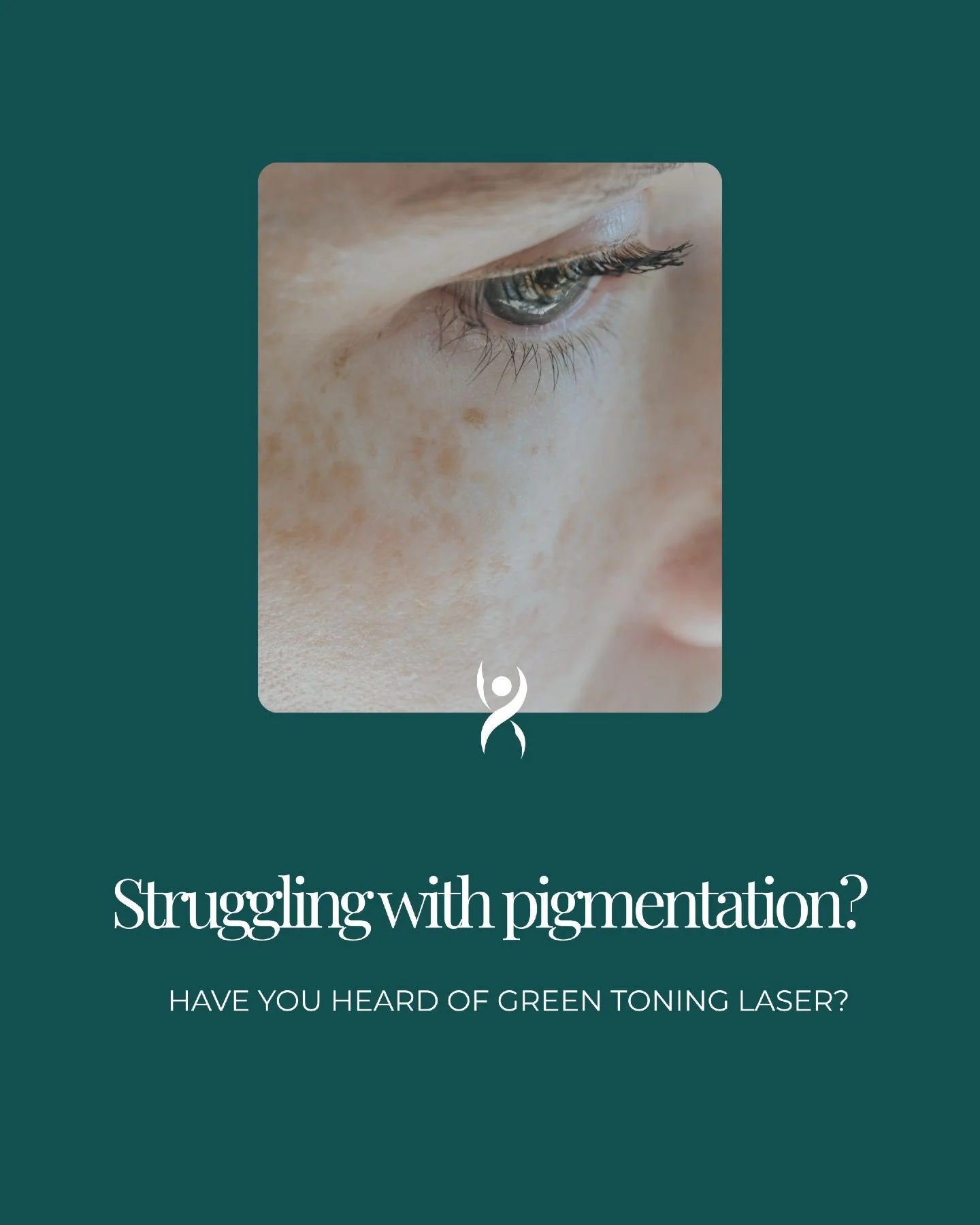 Pigmentation is one of those things that can feel really stubborn, and a lot of people don't know that green toning laser exists as an option.

It targets pigment at both the surface and deeper layers of the skin, without breaking the surface. Sun sp