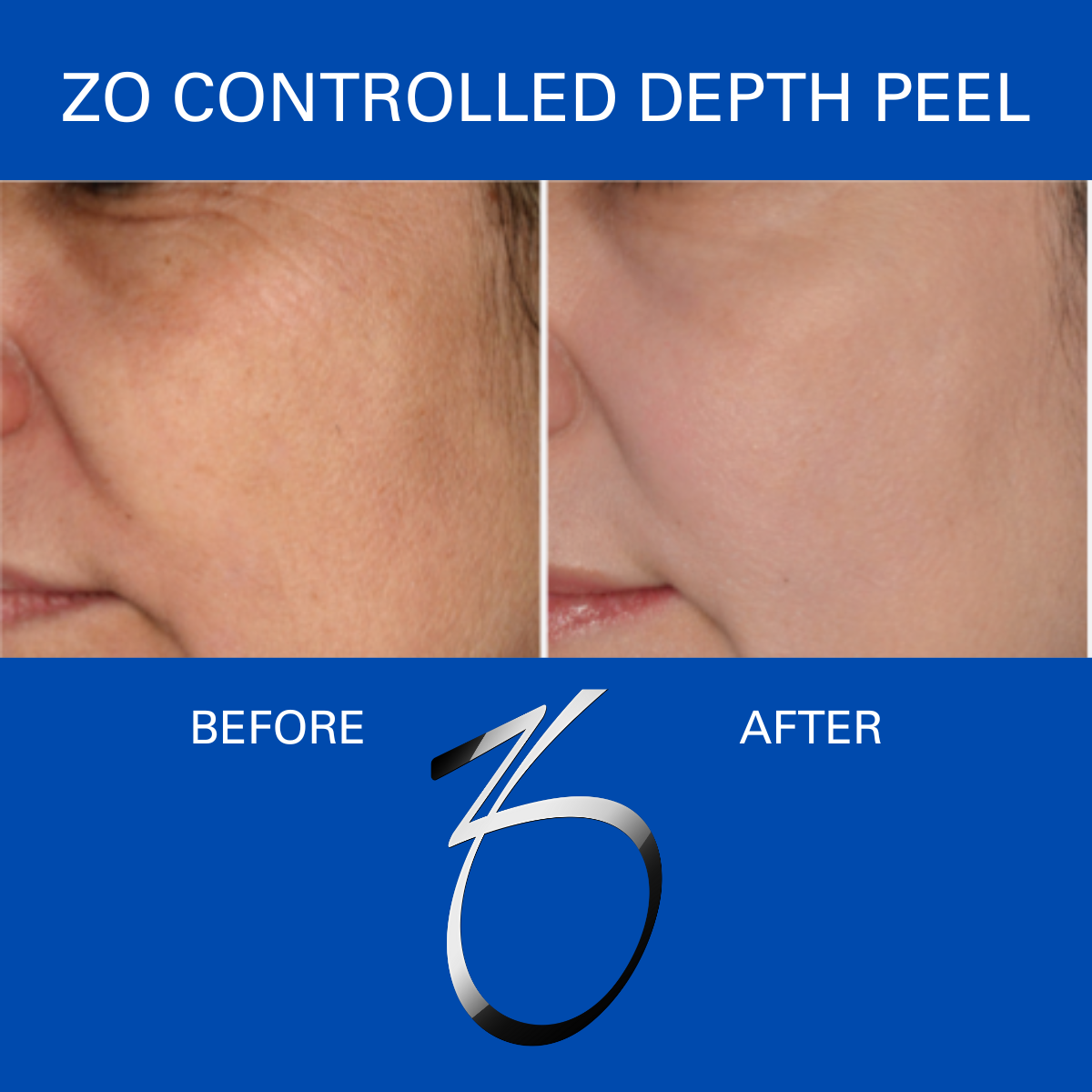 ZO CONTROLLED DEPTH PEEL.png
