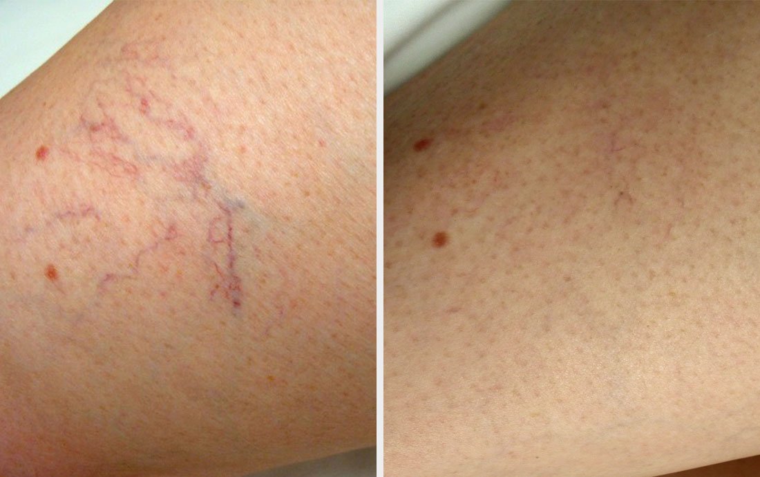 Sclerotherapy_leg_vein_removal-1093374720.jpg