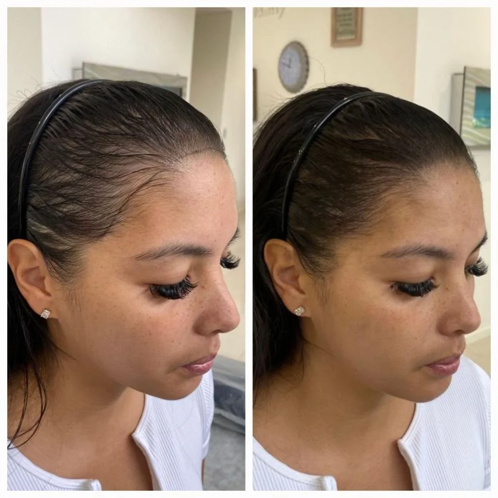 Scalp Micropigmentation