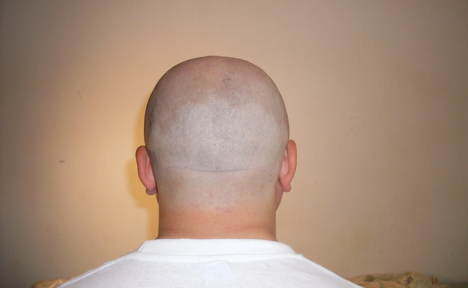 Bald_Man's_Nape.jpg