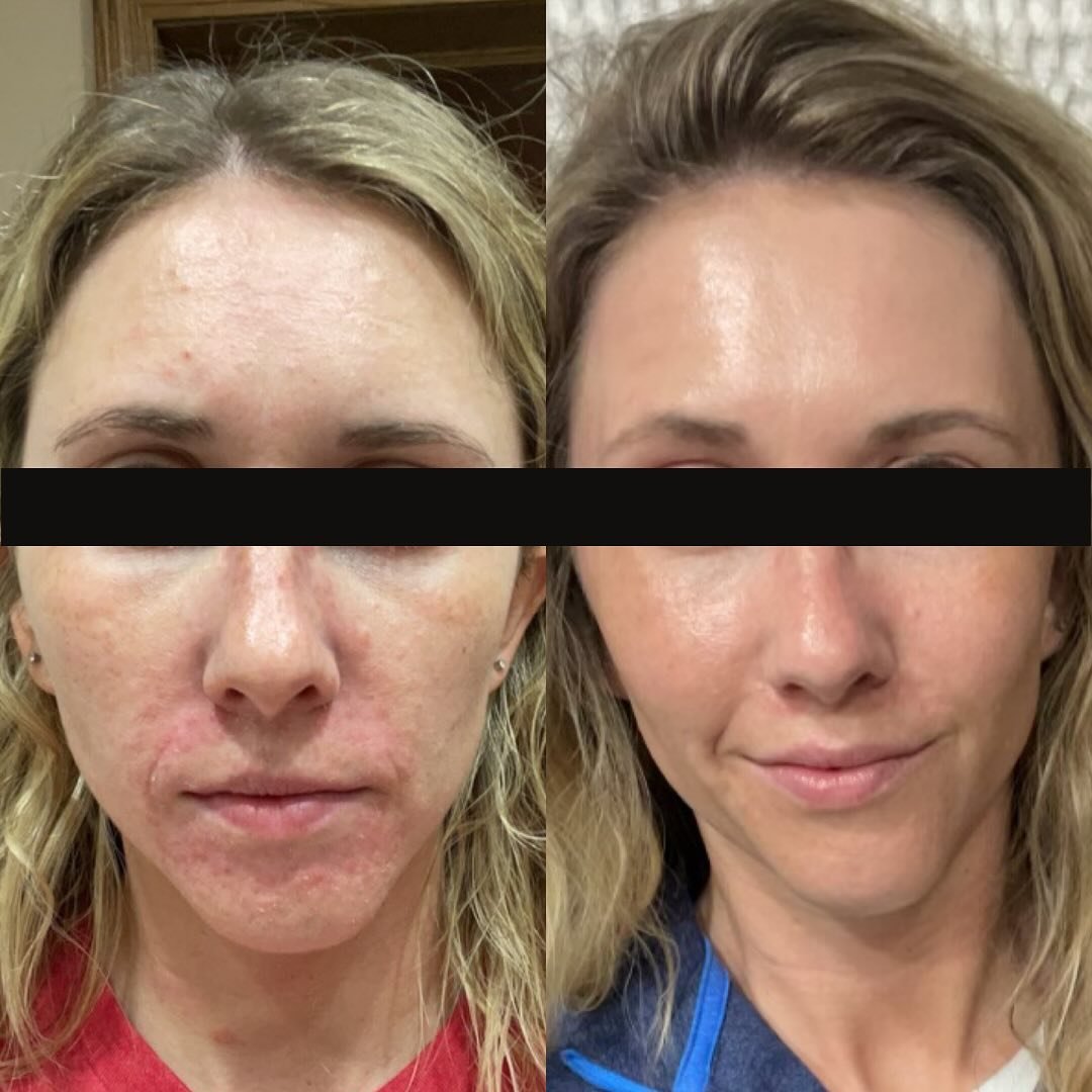 Another thing I did on maternity leave was go through client progress pictures and wooooooow! I am at a loss for words when it comes to the commitment + trust my clients put into caring for their skin. One of the many exciting parts of this career is
