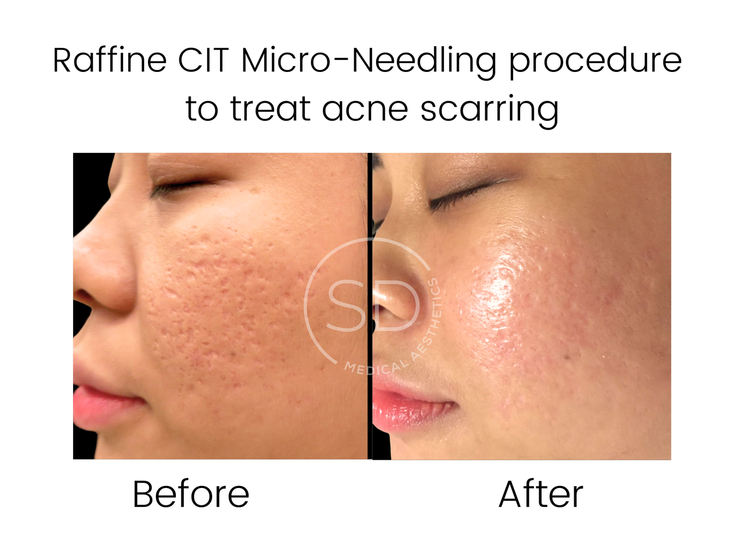 Raffine Micro-Needling Before and After Gallery — Skin Devices