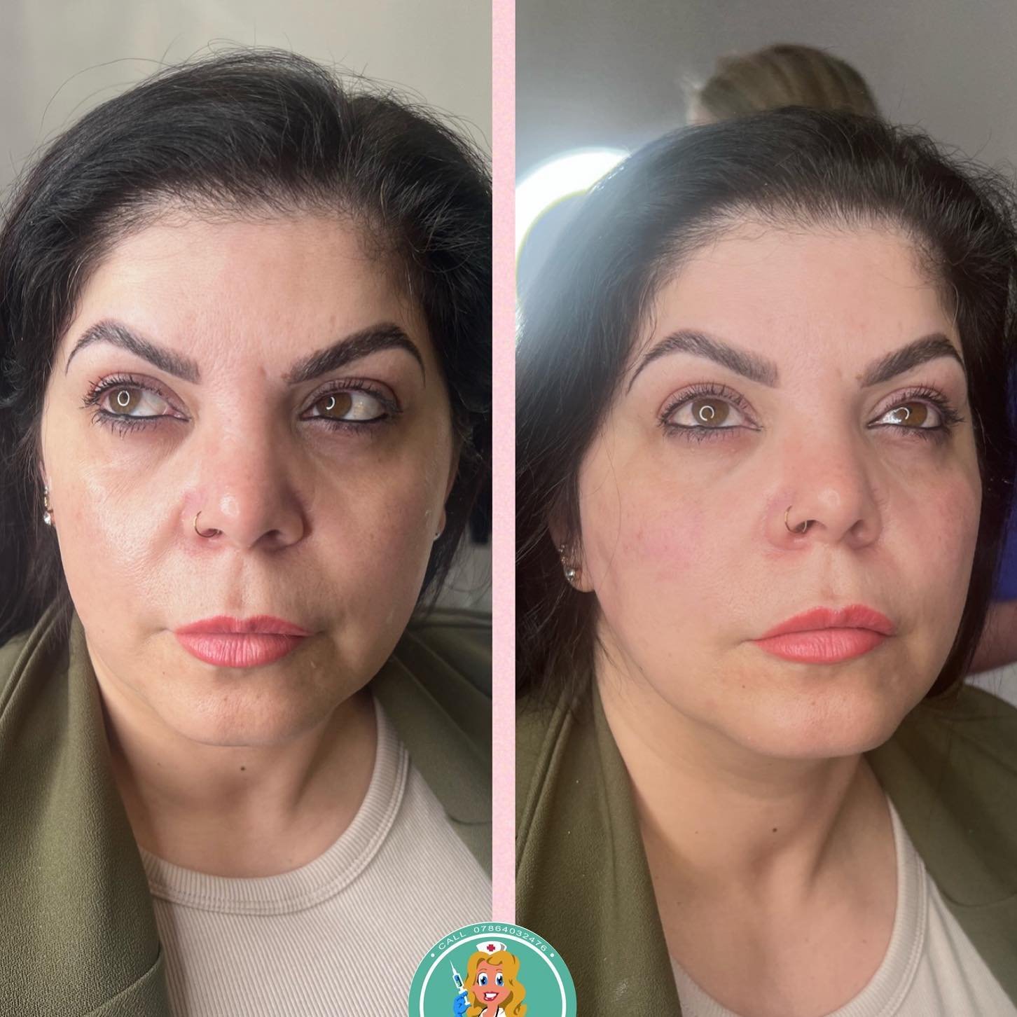 🌱 My gorgeous patient got a lovely refresh ✨🪄 Treating her Mid Face only to reduce hallows, tired eyes and deep folds. 
.
3ml used to create a fresher, less tired appearance 🥰 We are both delighted with the end result 👏 
.
@restylane @michaelhale