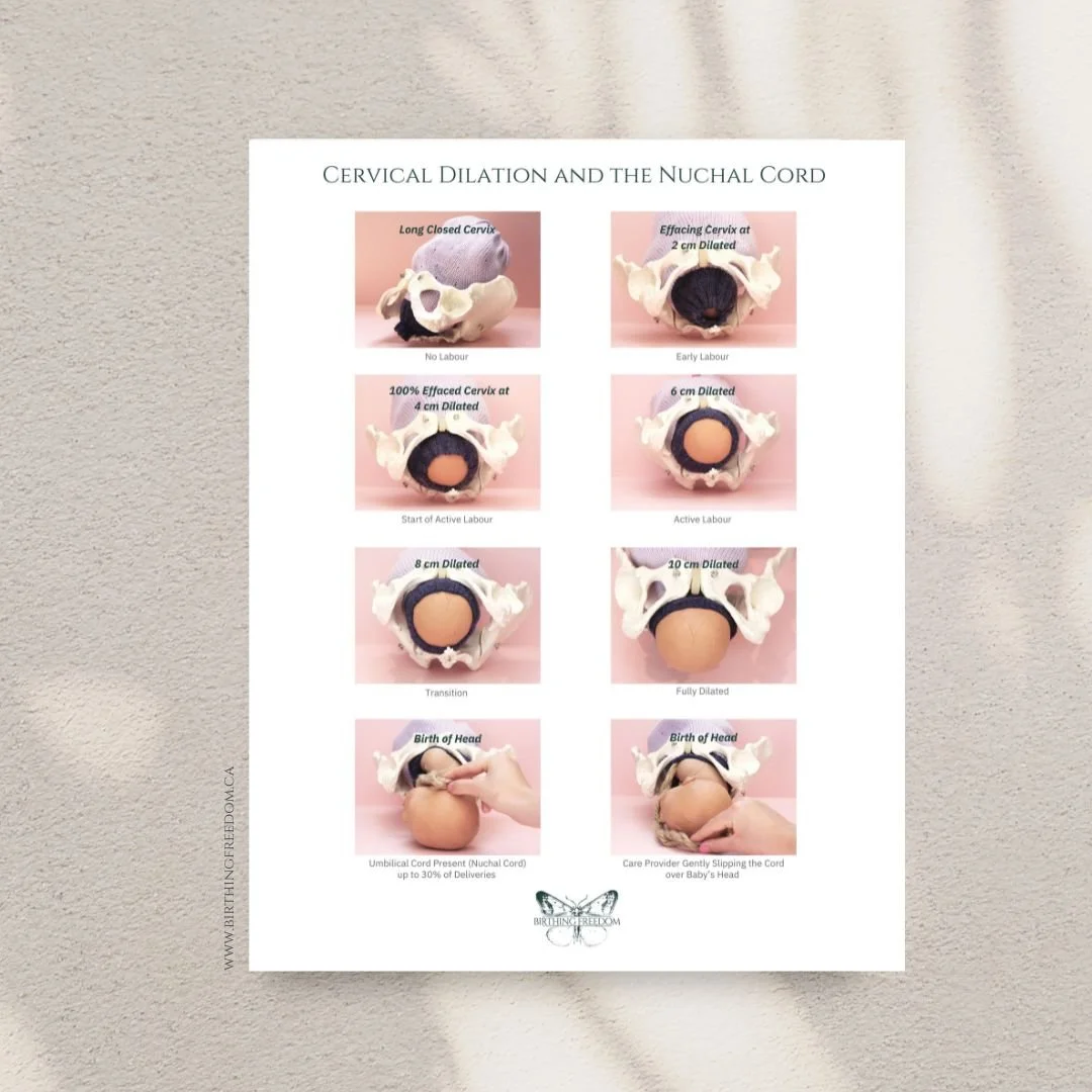 Cervical Dilation and the Nuchal Cord Poster — Birthing Freedom ...