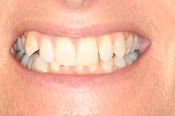 Overbite teeth before Invisalign in Essex