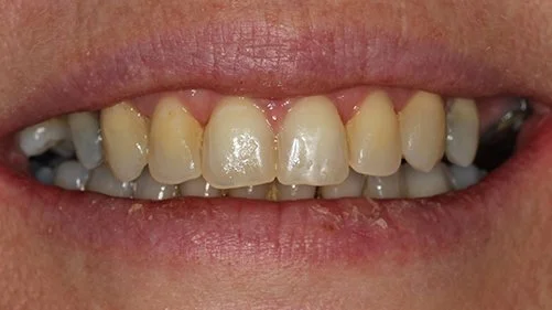 Invisalign treated gappy teeth in Essex