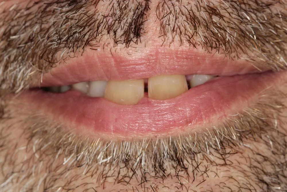Overjet teeth before Invisalign in Essex
