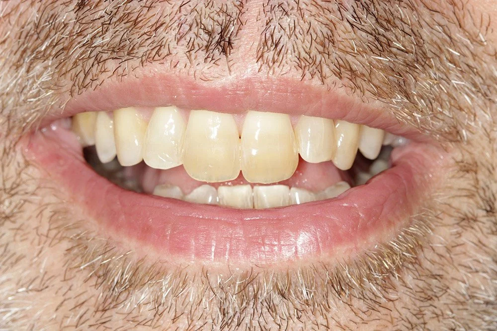 Overjet gone after Invisalign in Essex