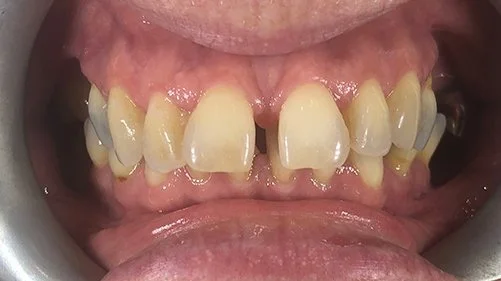 Gappy teeth in Essex, before Invisalign