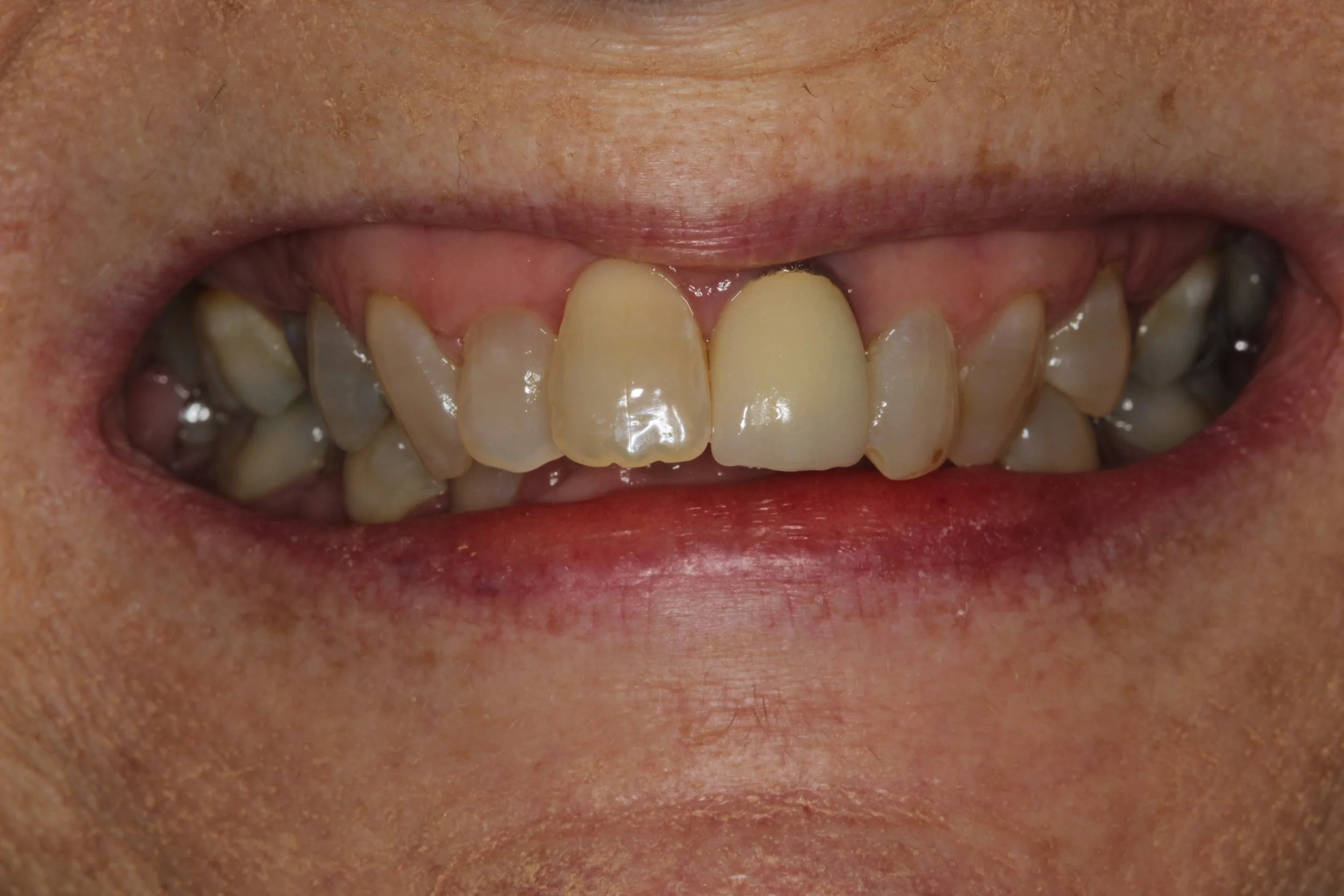 Crowded teeth after Invisalign in Essex